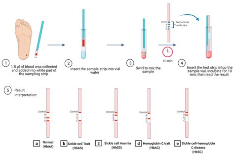 Techniques for the Detection of Sickle Cell Disease: A Review